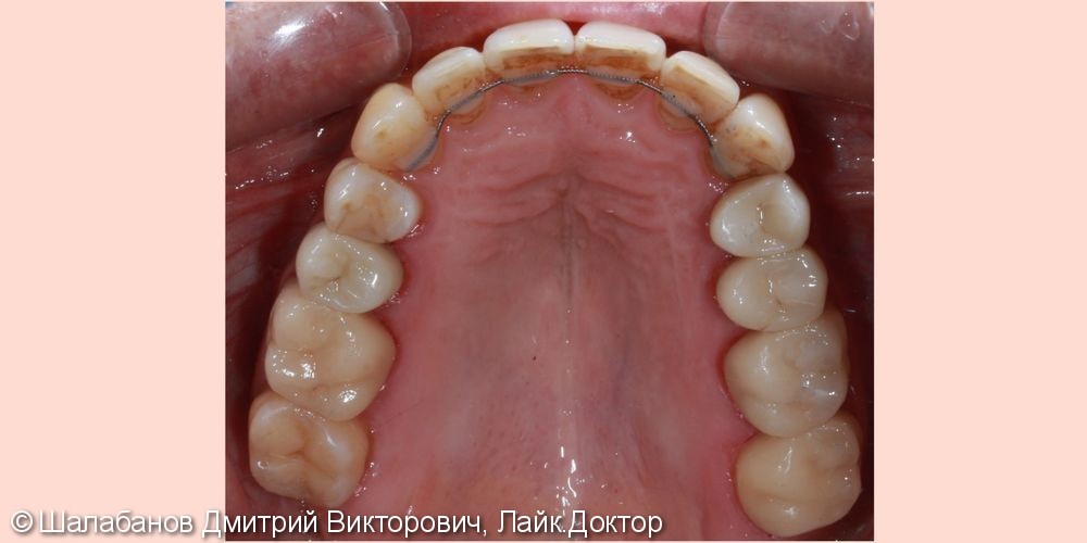 Исправление прикуса с установкой коронок на импланты и зубы - фото №10