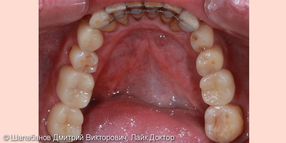 Исправление прикуса с установкой коронок на импланты и зубы - фото №11