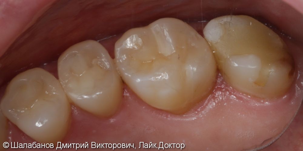Восстановление зуба с использованием технологии Cerec - фото №1