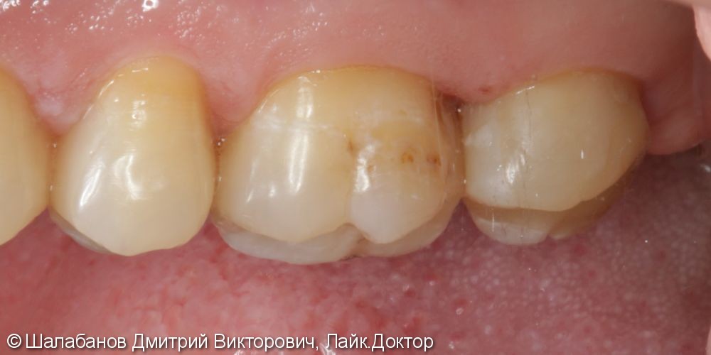 Восстановление зуба с использованием технологии Cerec - фото №2