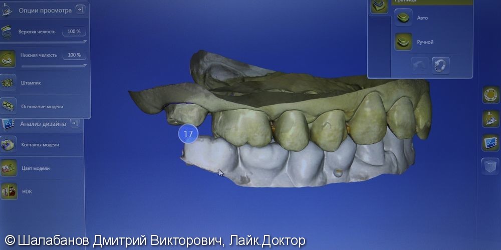 Восстановление зуба с использованием технологии Cerec - фото №3