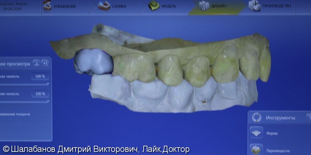Восстановление зуба с использованием технологии Cerec - фото №4