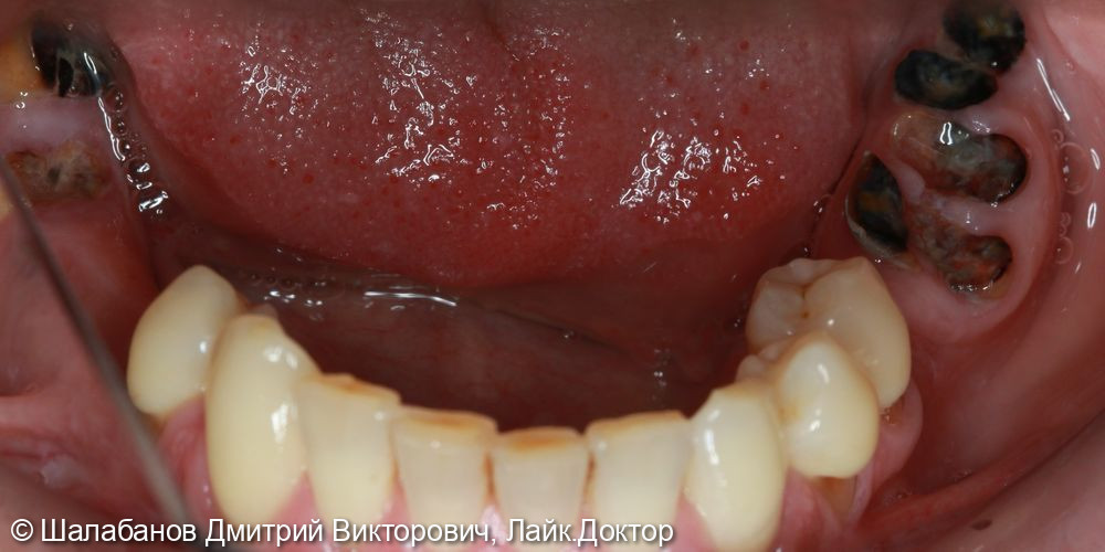 Восстановление зубного ряда при значительной потере зубов - фото №3