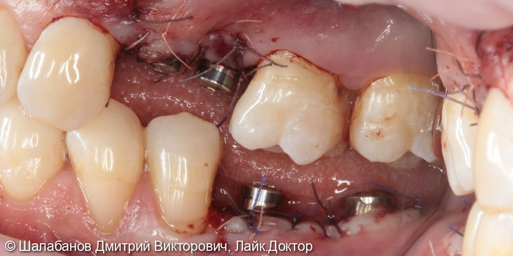 Восстановление зубного ряда при значительной потере зубов - фото №4