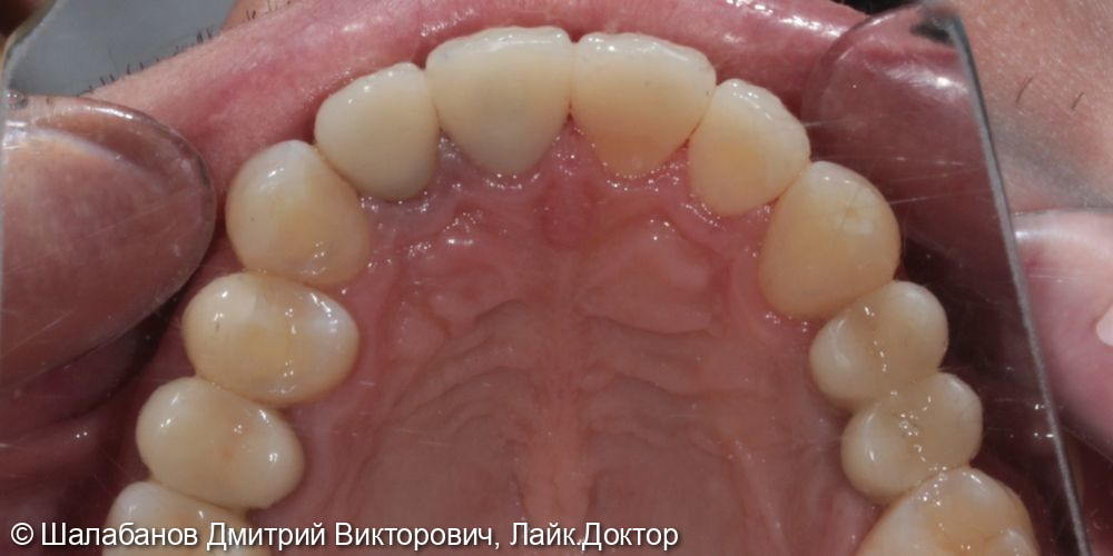 Восстановление зубного ряда при значительной потере зубов - фото №5