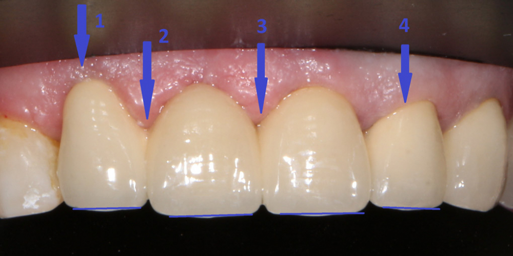 Замена металлокерамических коронок на линии улыбки - фото №2