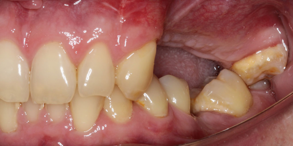 Отсутствие зубов в течение длительного времени, затрудненное пережевывание пищи, эстетический дефект - фото №1