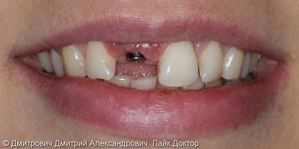 Одномоментная имплантация Astra Tech переднего зуба - фото №4