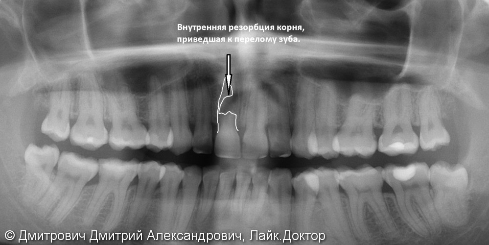 Одномоментная имплантация Astra Tech переднего зуба - фото №2
