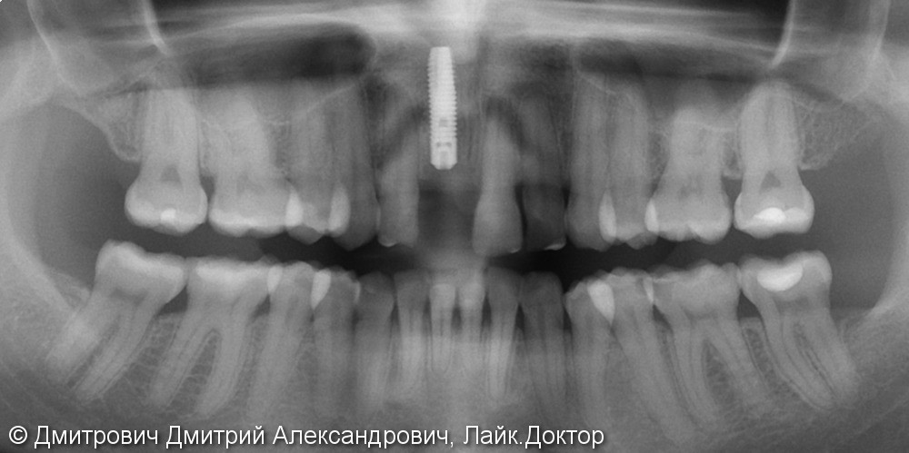 Одномоментная имплантация Astra Tech переднего зуба - фото №3