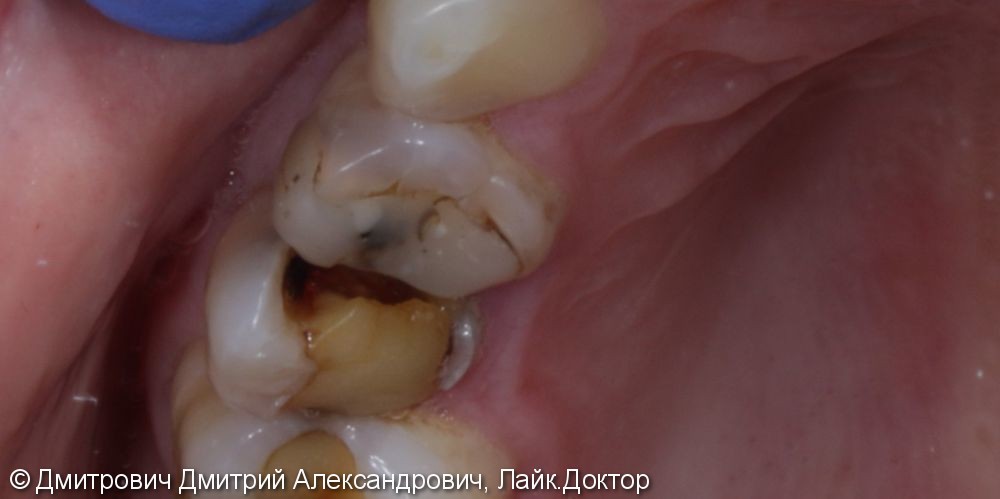 Удаление зубов и одномоментная установка имплантатов Astra Tech - фото №2