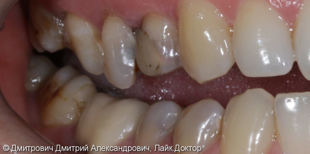 Удаление зубов и одномоментная установка имплантатов Astra Tech - фото №1