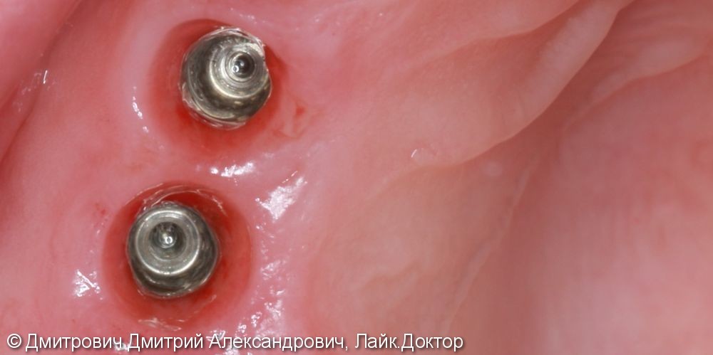 Удаление зубов и одномоментная установка имплантатов Astra Tech - фото №3