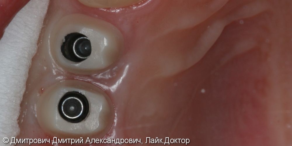 Удаление зубов и одномоментная установка имплантатов Astra Tech - фото №4