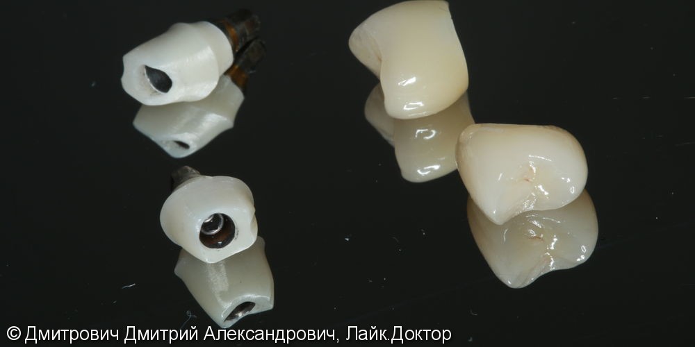 Удаление зубов и одномоментная установка имплантатов Astra Tech - фото №5