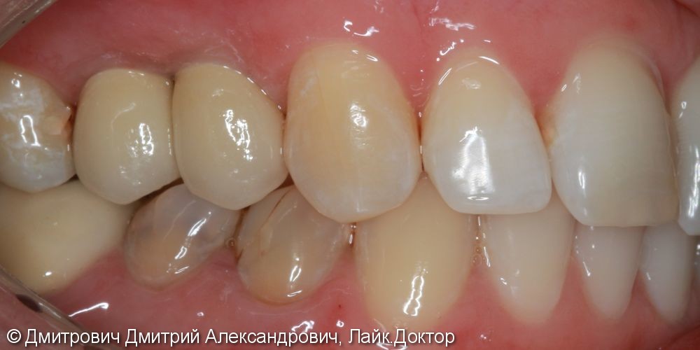 Удаление зубов и одномоментная установка имплантатов Astra Tech - фото №7