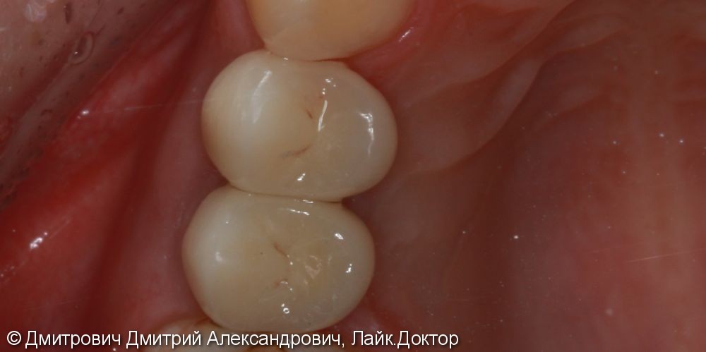 Удаление зубов и одномоментная установка имплантатов Astra Tech - фото №6