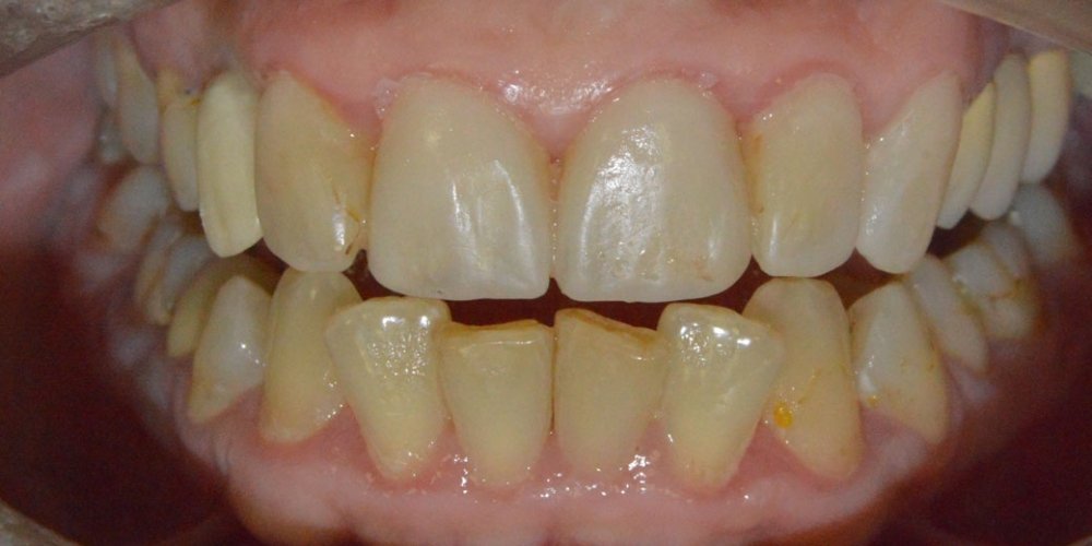Протезирование передних зубов керамическими винирами Емах - фото №1