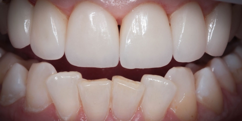 Протезирование передних зубов керамическими винирами Емах - фото №2