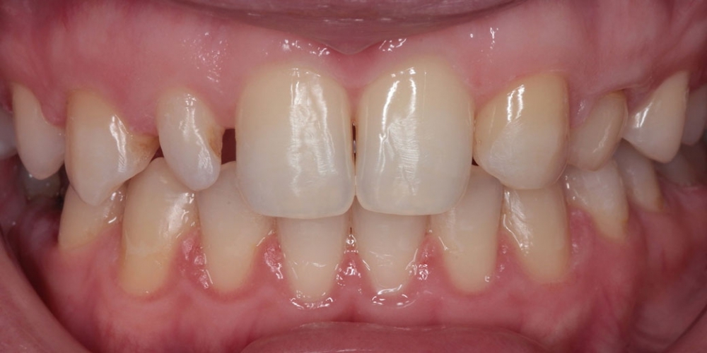 Шипковидный зуб в зоне улыбки, исправление винирами - фото №1