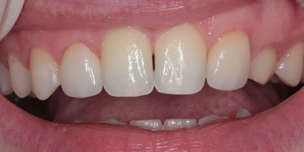 Шипковидный зуб в зоне улыбки, исправление винирами - фото №2