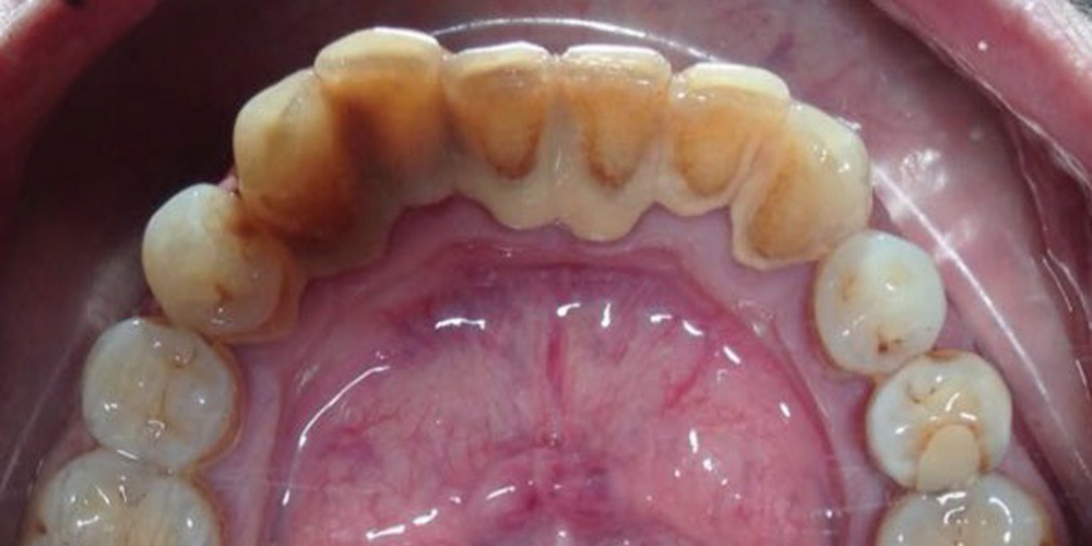 Устранение зубных отложений, кровоточивости и воспаления дёсен - фото №1