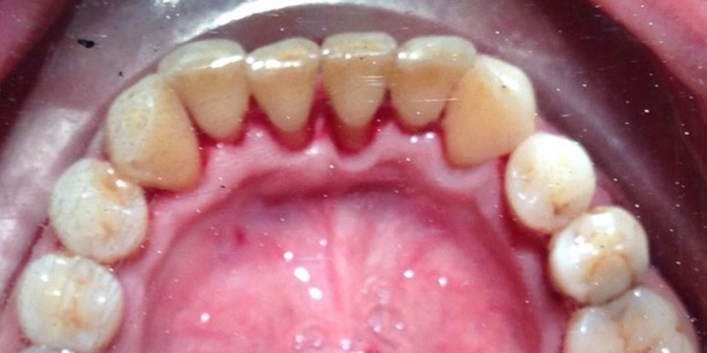 Устранение зубных отложений, кровоточивости и воспаления дёсен - фото №2