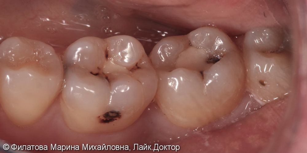 Потемнение эмали в области жевательных зубов нижней челюсти - фото №1