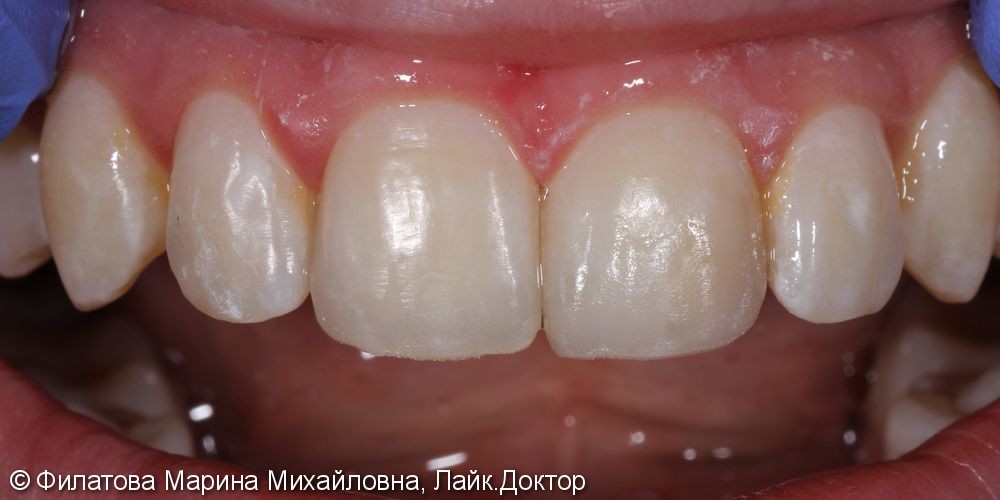 Восстановление зубов композитным материалом, до и после - фото №2
