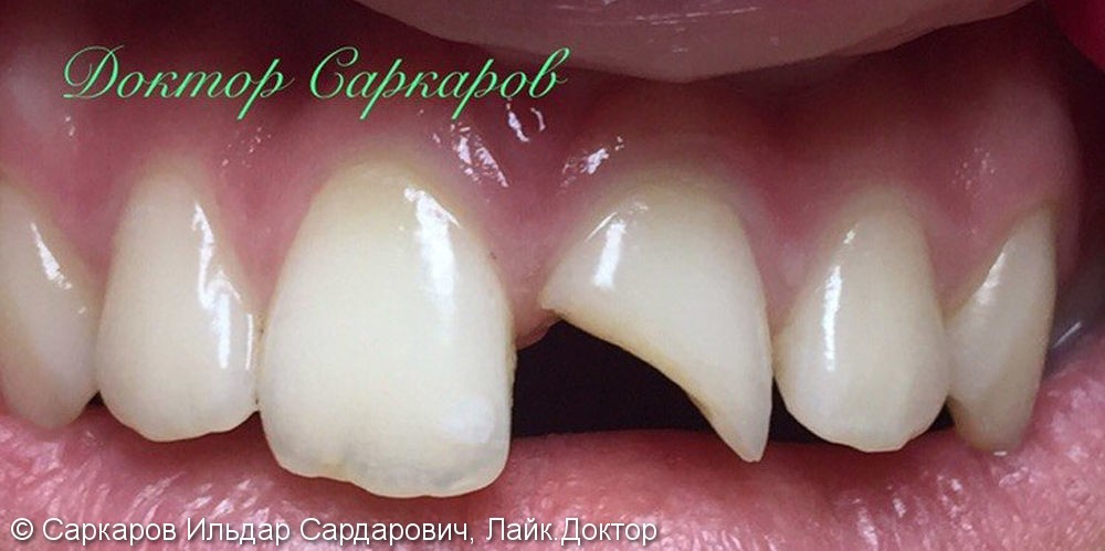 Реставрация переднего зуба у ребенка после травматического скола, до и после - фото №1