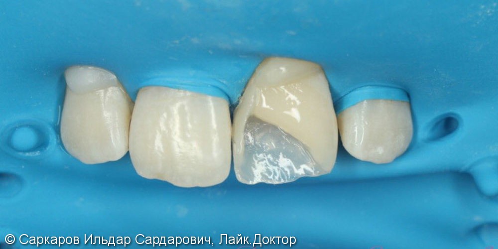 Реставрация переднего зуба у ребенка после травматического скола, до и после - фото №2