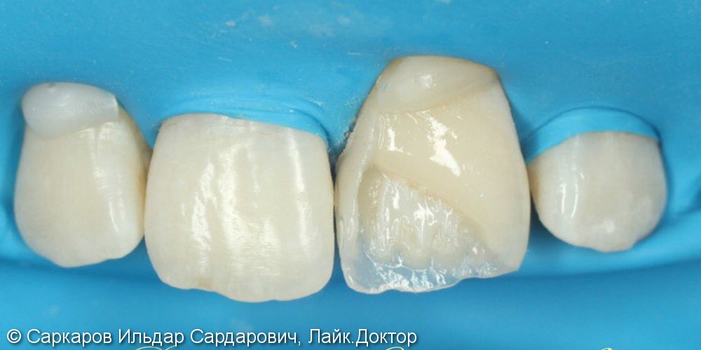 Реставрация переднего зуба у ребенка после травматического скола, до и после - фото №3