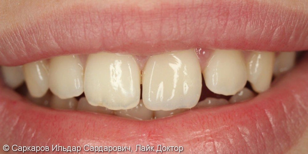 Реставрация переднего зуба у ребенка после травматического скола, до и после - фото №4