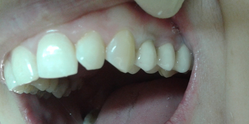 Протезирование верхних зубов металлокерамическими коронками - фото №4