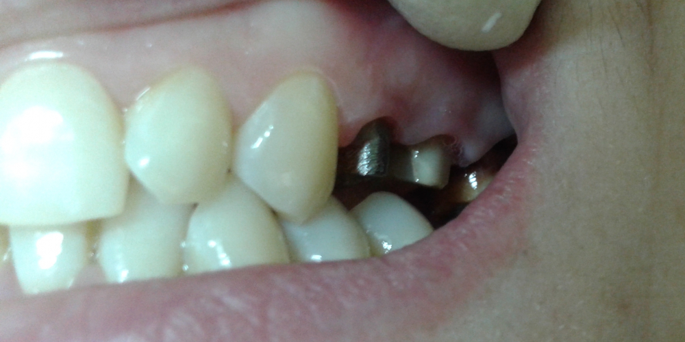 Протезирование верхних зубов металлокерамическими коронками - фото №3