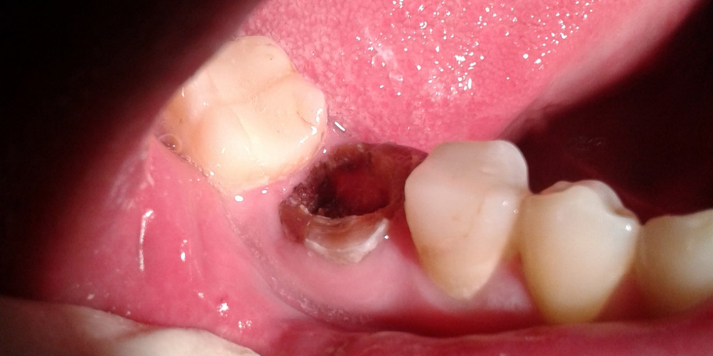 Восстановление 46 зуба культевой вкладкой и металлокерамической коронкой - фото №1