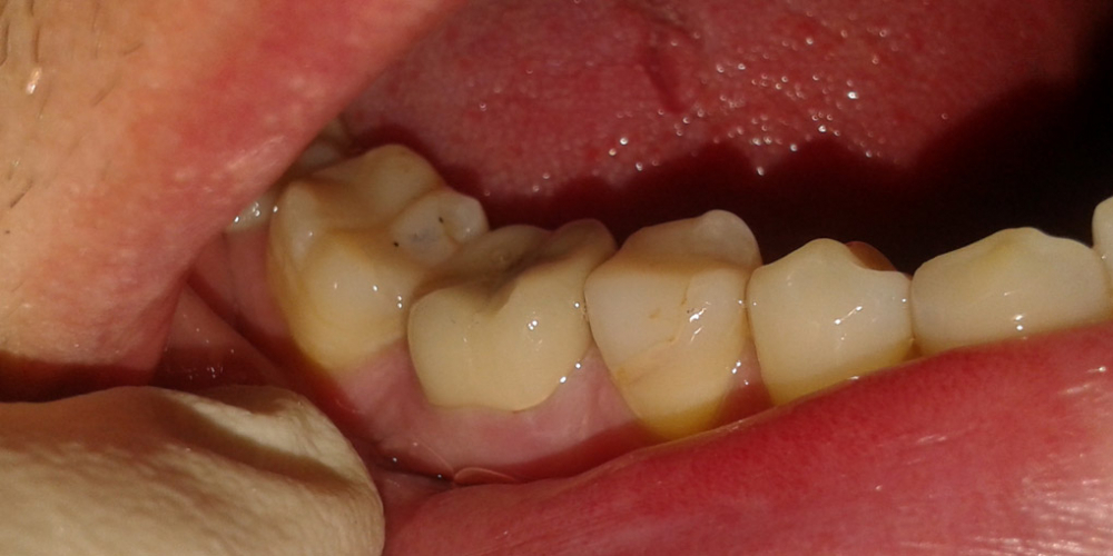 Восстановление 46 зуба культевой вкладкой и металлокерамической коронкой - фото №2