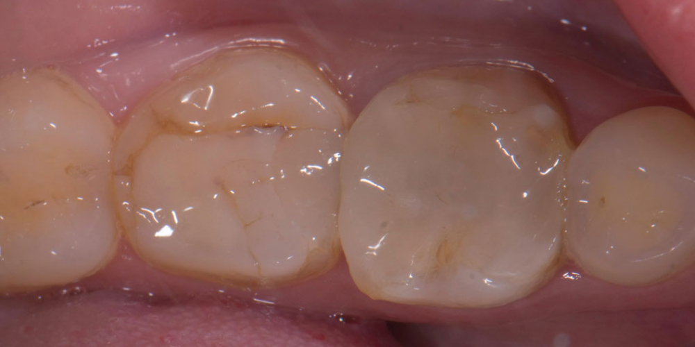 Восстановление двух зубов керамическими вкладками - фото №1