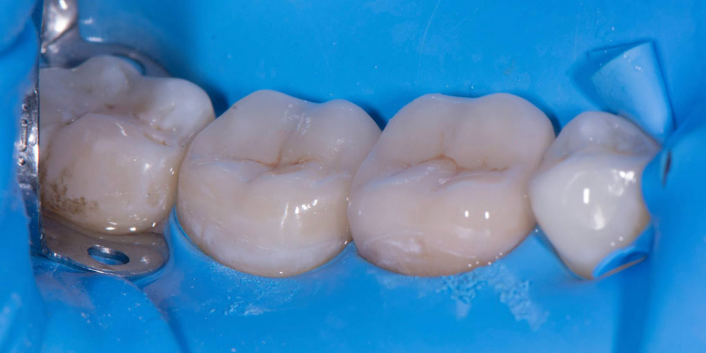 Восстановление двух зубов керамическими вкладками - фото №6