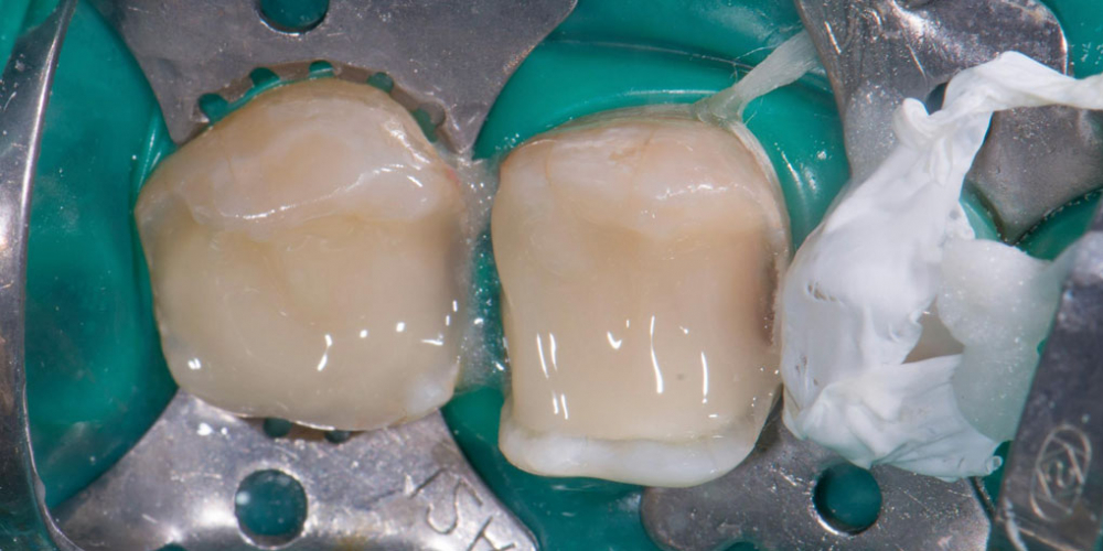 Восстановление двух зубов керамическими вкладками - фото №4
