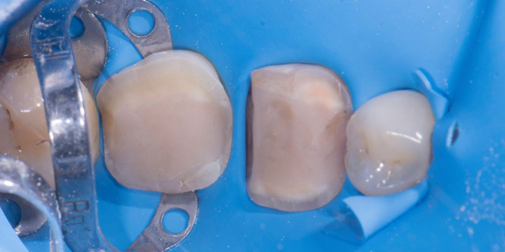 Восстановление двух зубов керамическими вкладками - фото №5