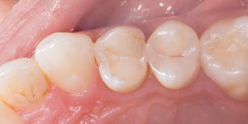 Реставрация зуба керамическим виниром в эстетически значимой зоне - фото №1