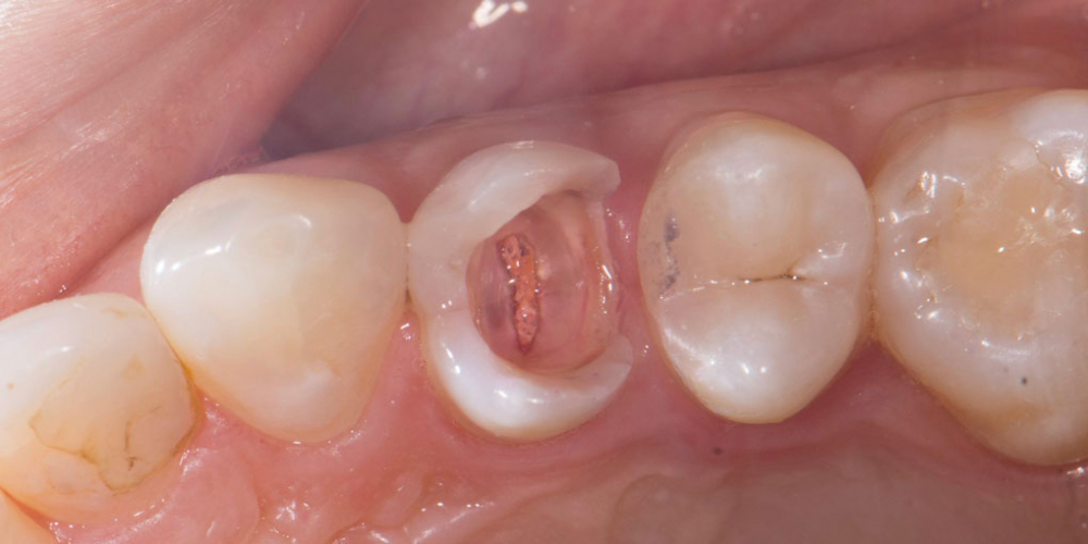 Реставрация зуба керамическим виниром в эстетически значимой зоне - фото №3