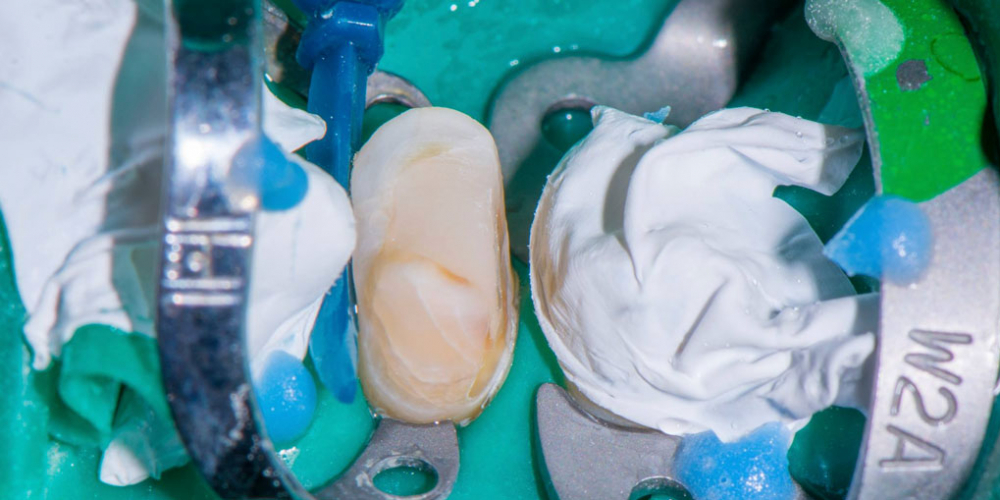 Реставрация зуба керамическим виниром в эстетически значимой зоне - фото №4
