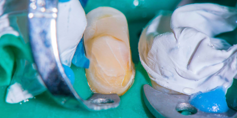Реставрация зуба керамическим виниром в эстетически значимой зоне - фото №5
