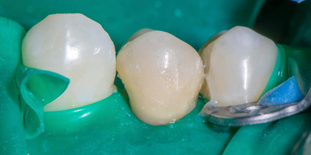 Реставрация зуба керамическим виниром в эстетически значимой зоне - фото №6