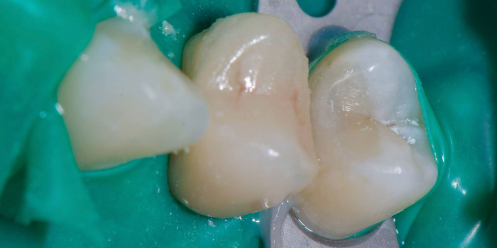 Реставрация зуба керамическим виниром в эстетически значимой зоне - фото №7