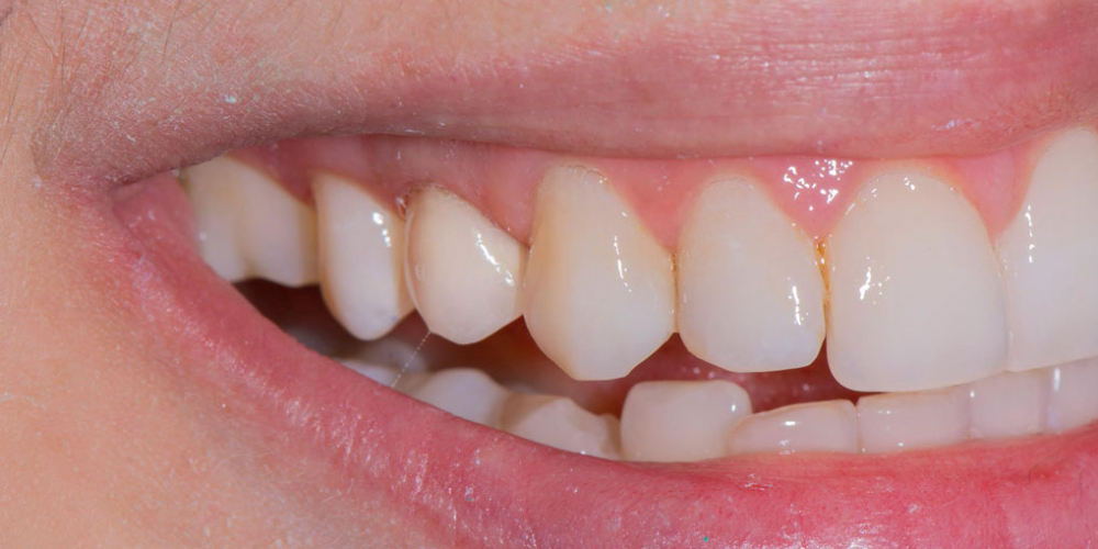 Реставрация зуба керамическим виниром в эстетически значимой зоне - фото №2