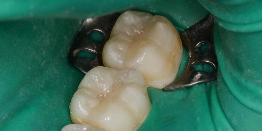 Результат восстановление зубов нанокомпозитной пломбой - фото №2
