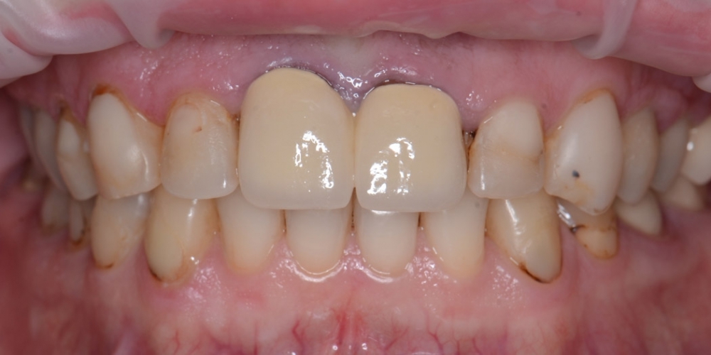 Тотальная реконструкция улыбки с протезированием на имплантах безметалловыми короноками и винирами - фото №1